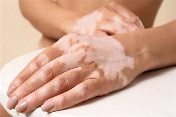 تازه‌ترین توصیه‌های پزشکی برای کنترل لک‌های پوستی