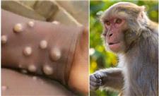 وزارت بهداشت: «آبله میمونی» هنوز به ایران نرسیده است