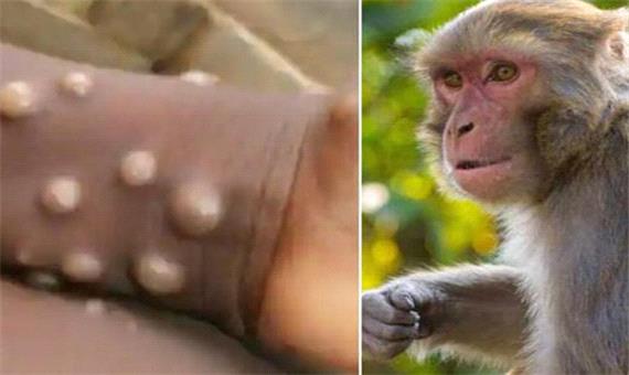 شناسایی 6 بیمار مشکوک به آبله میمون در ایران