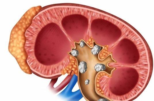 روش‌های مختلف سنگ شکنی سنگ کلیه چگونه است؟