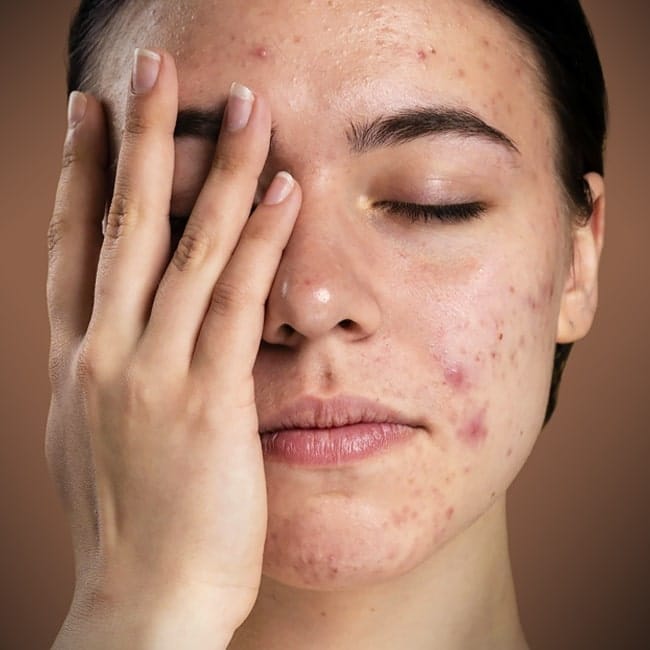 از چه راه هایی می توان جوش و جای جوش را از بین برد؟