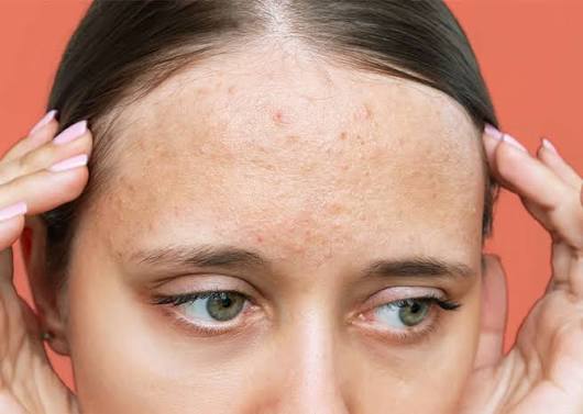 بهترین درمان برای جوش های زیرپوستی و چرکی چیست؟