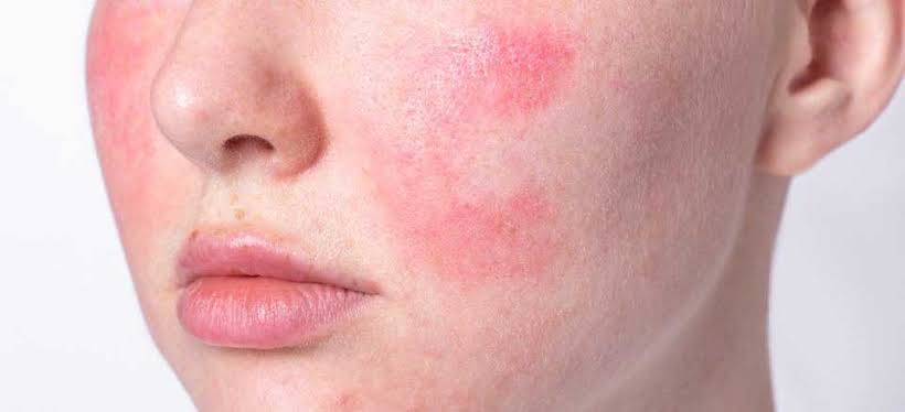 بیماری روزاسه پوستی چیست؟