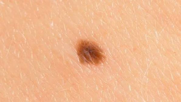 علت خال در آوردن در نقاط مختلف بدن چیست؟