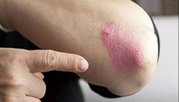 از بیماری «پسوریازیس» چه می دانید