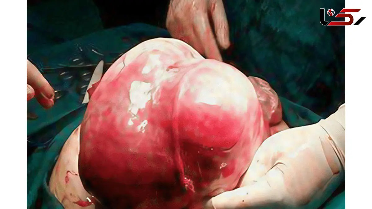توده ۷ کیلویی از رحم یک بیمار در اردبیل خارج شد