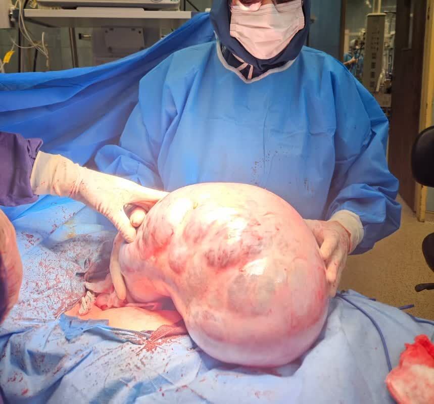 خارج‌ کردن توده ۱۰ کیلویی از شکم بیمار