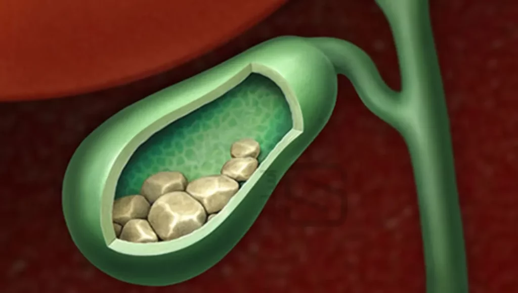 گیاهان مفید برای کیسه صفرا
