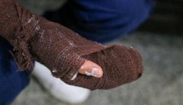 انگشتان پسر ۱۶ ساله اصفهانی، قربانی جدید ترقه‌بازی