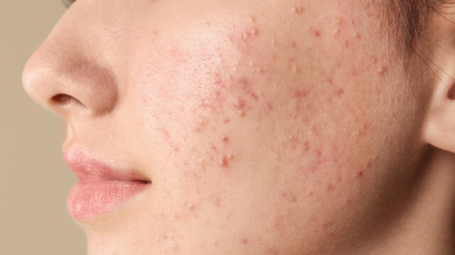 نسخه شخصی دکتر برای درمان جوش!