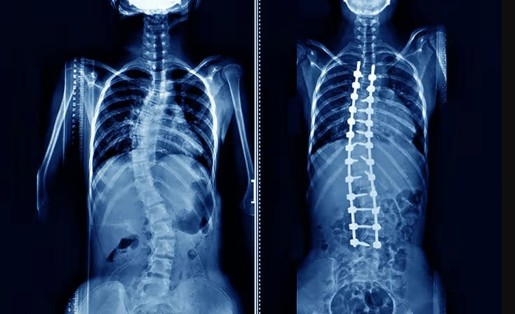 ۶ نسخه خطرناکِ خانگی در انحراف ستون فقرات