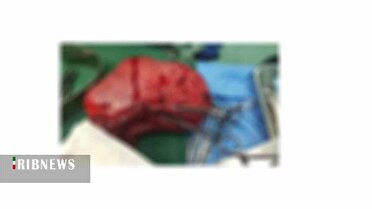 برداشتن توده ۲ کیلویی از شکم خانمی ۴۲ ساله