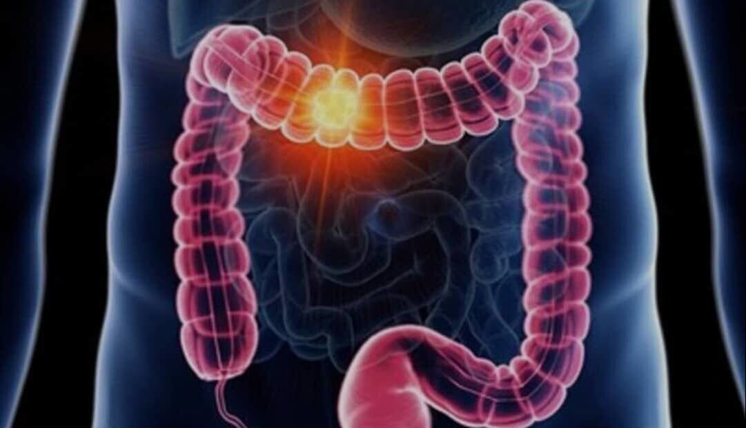 علائم گوارشی را ساده نگیرید/ هر خون‌ریزی هموروئید نیست