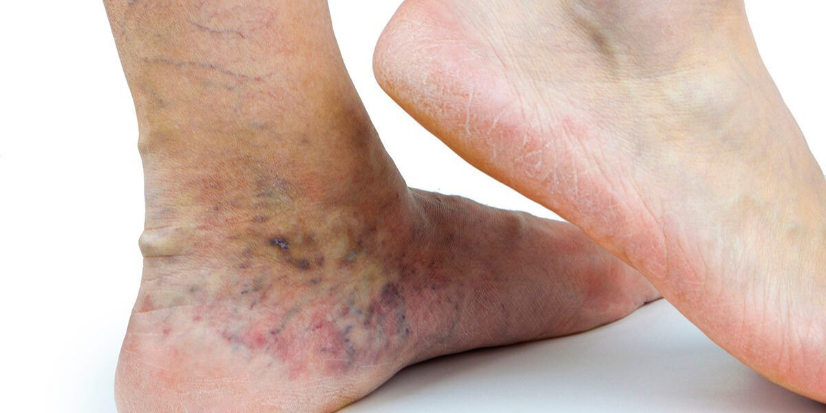 بیماری واریس چیست؟