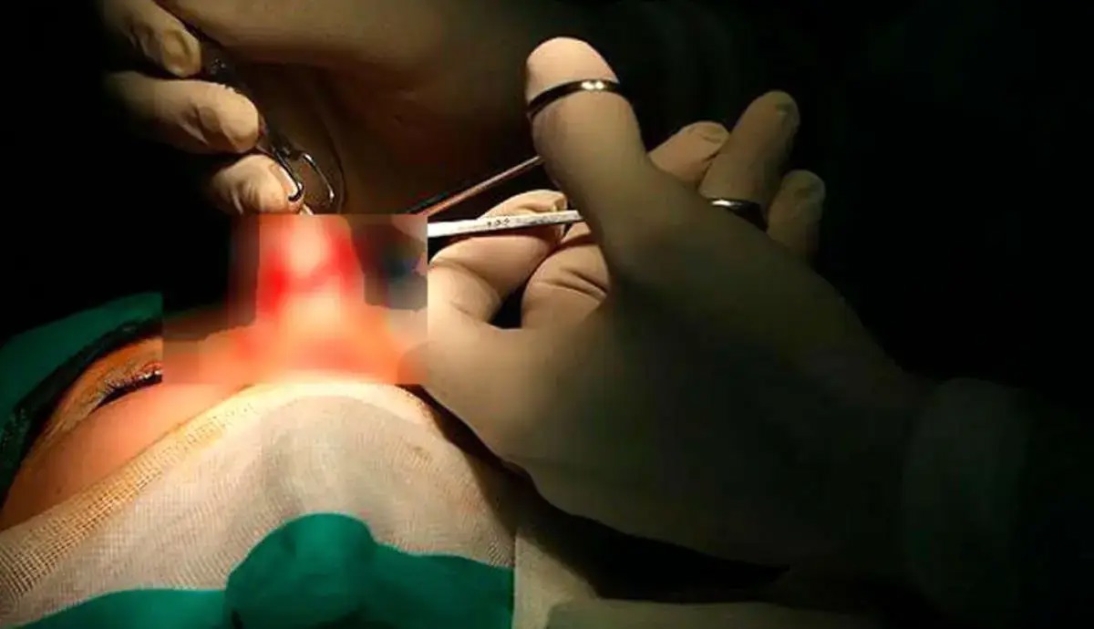 زن جوان هنگام عمل جراحی بینی جان باخت