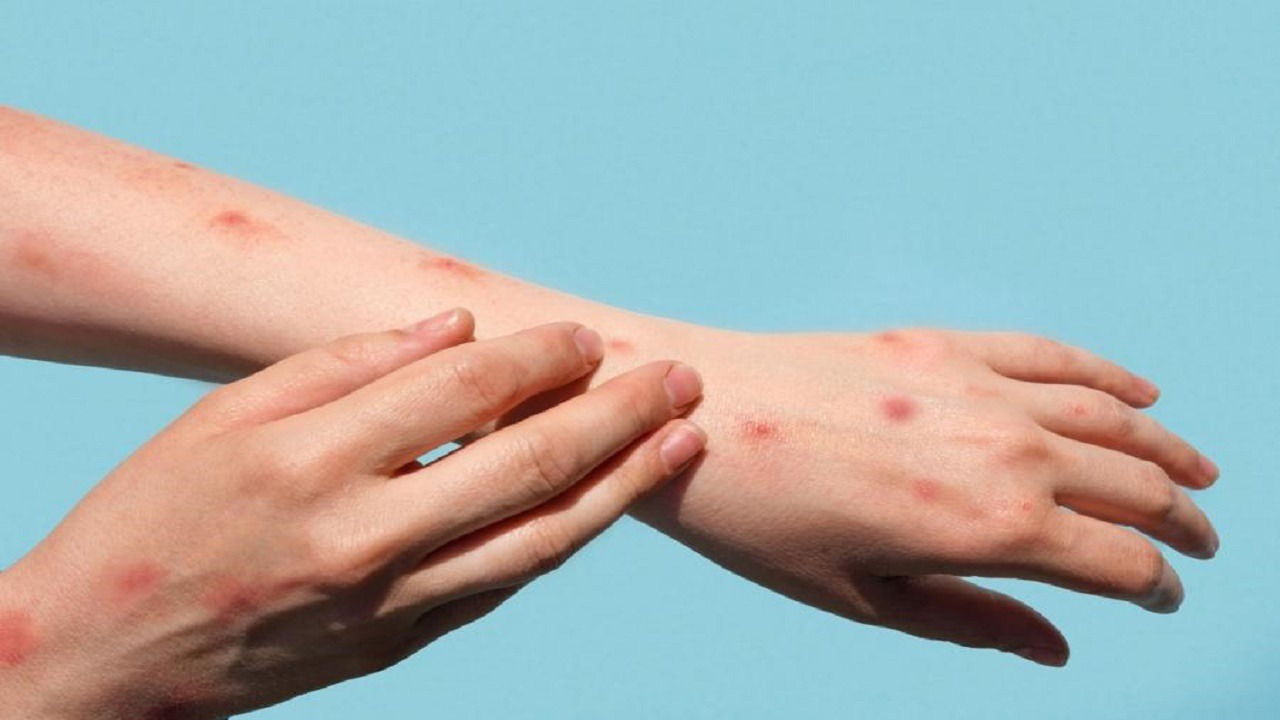 یک علت غیرمنتظره برای زخم‌های پوستی