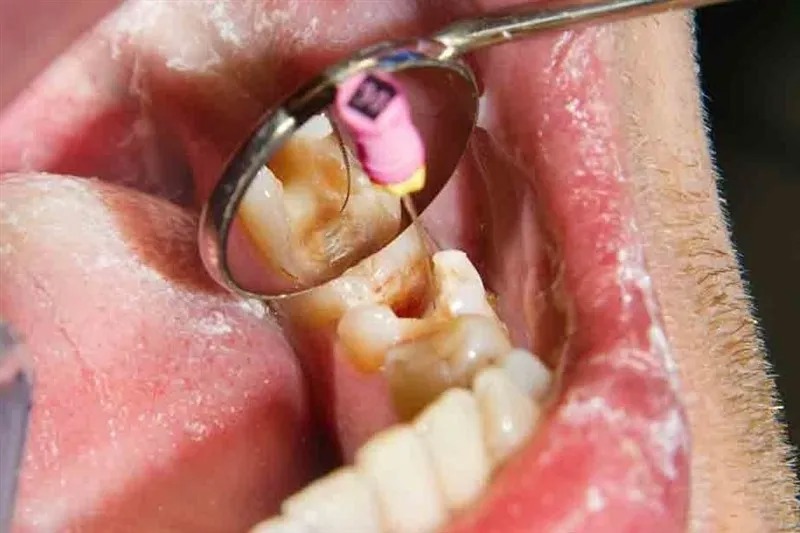 آغاز ارائه خدمات عصب‌کشی با تعرفه دولتی در مراکز منتخب